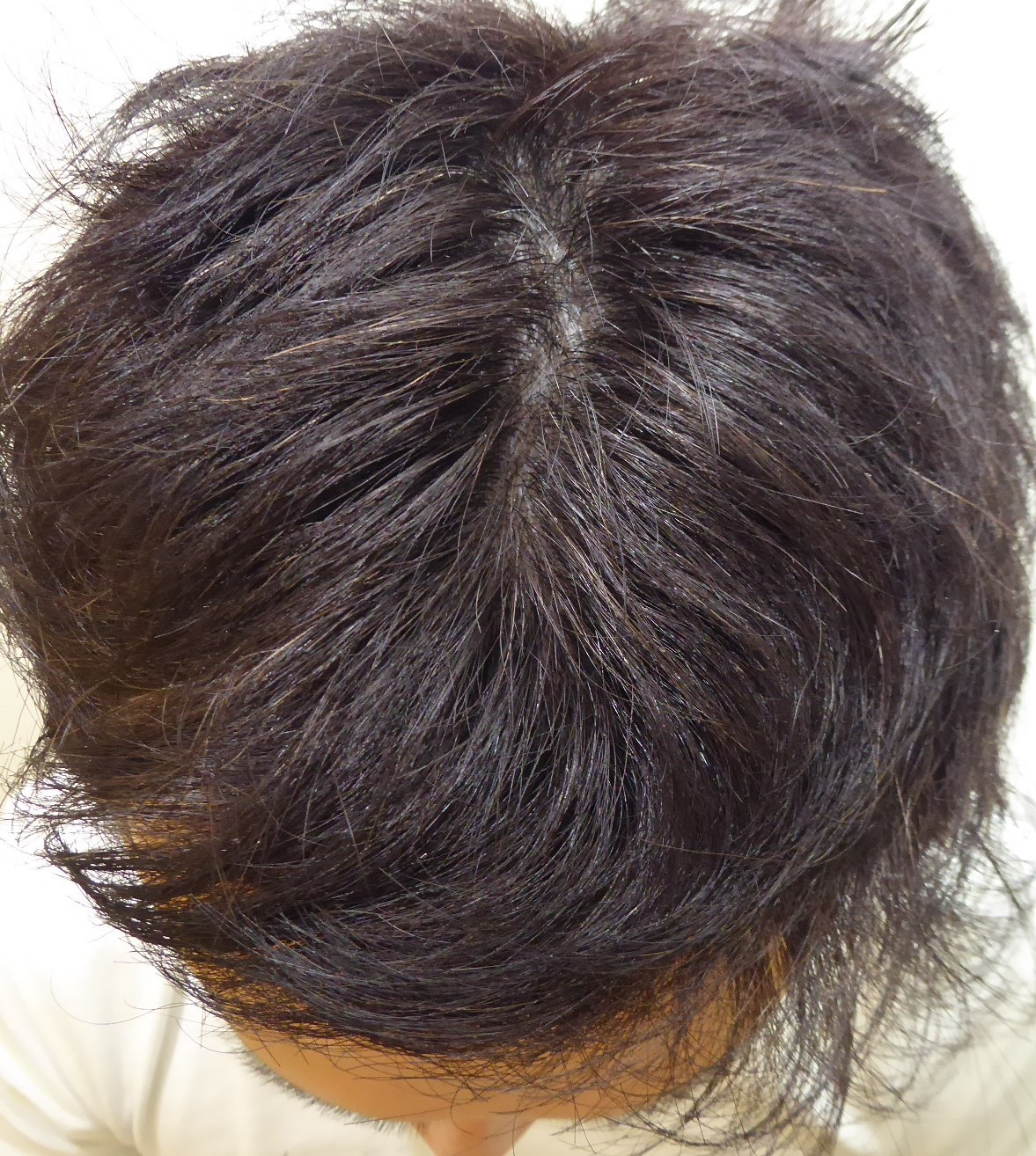 30代のAGA治療　抜け毛が止まる秘訣　3ヶ月発毛のコツとは？