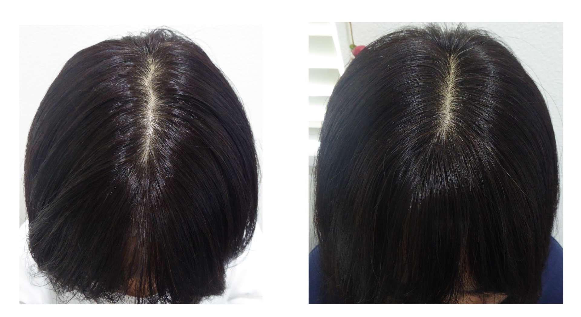 AGA・姫路発毛サロン　40代女性【あんなに悩んでいたのに・・・】