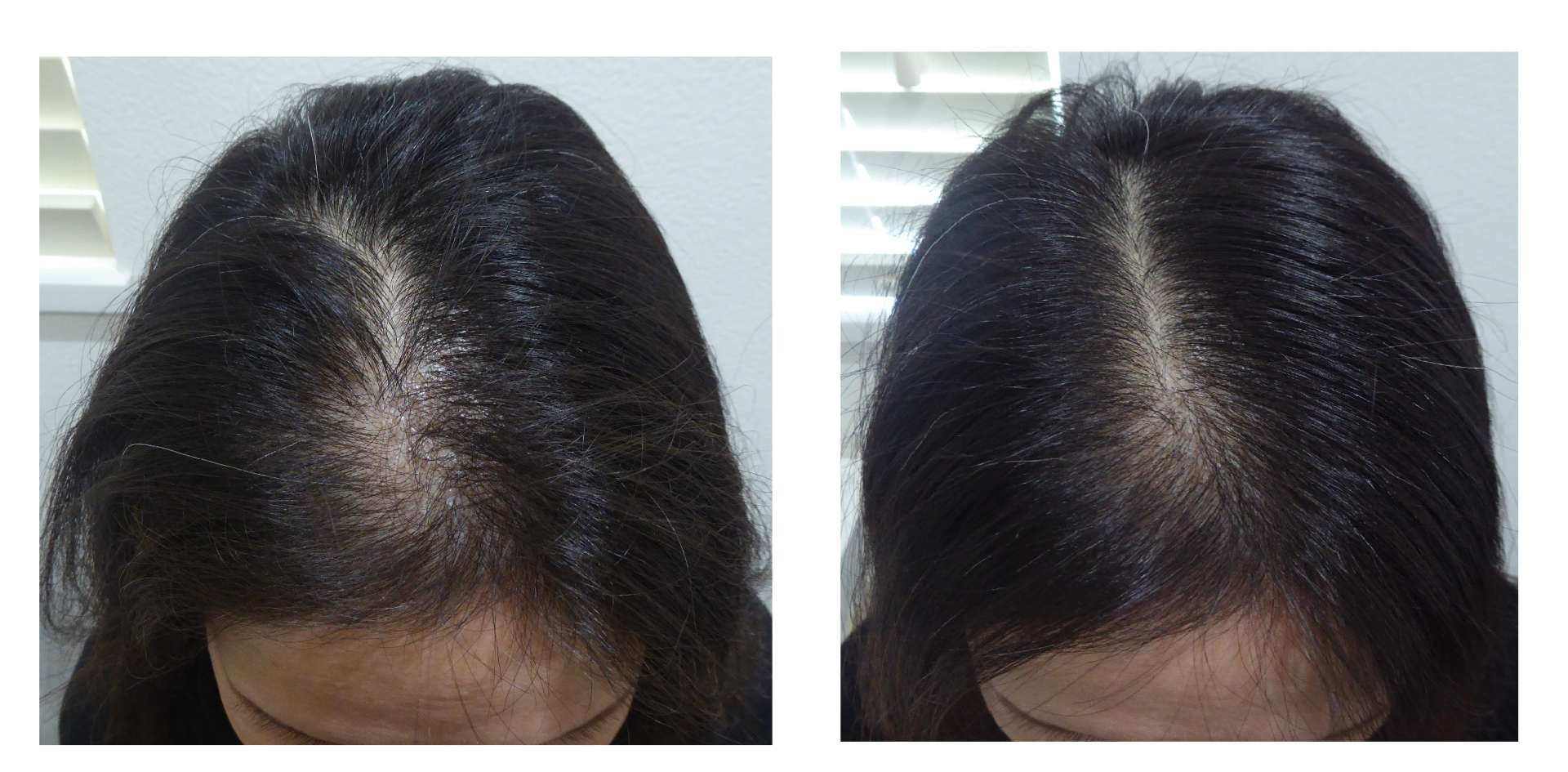 AGA・姫路発毛サロン　50代女性【ホンマに生える？？】