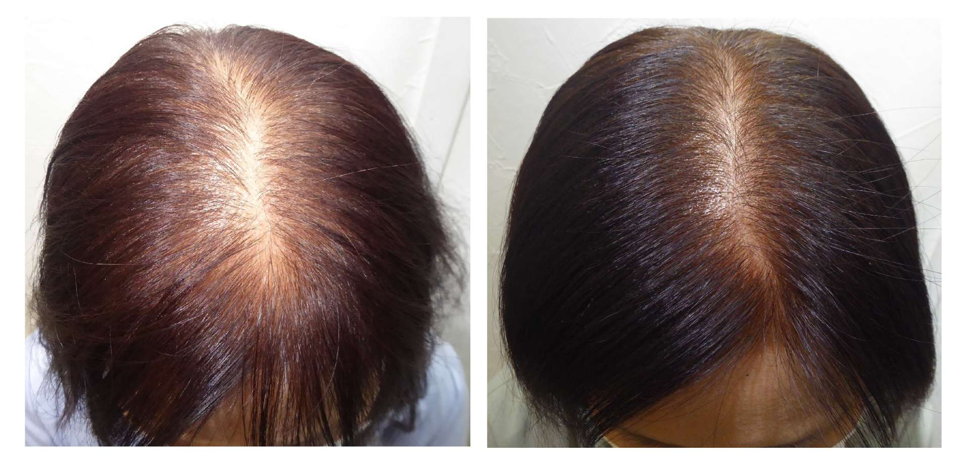 AGA・姫路発毛サロン サロン選びで【後悔しない為】に大切なこと!!