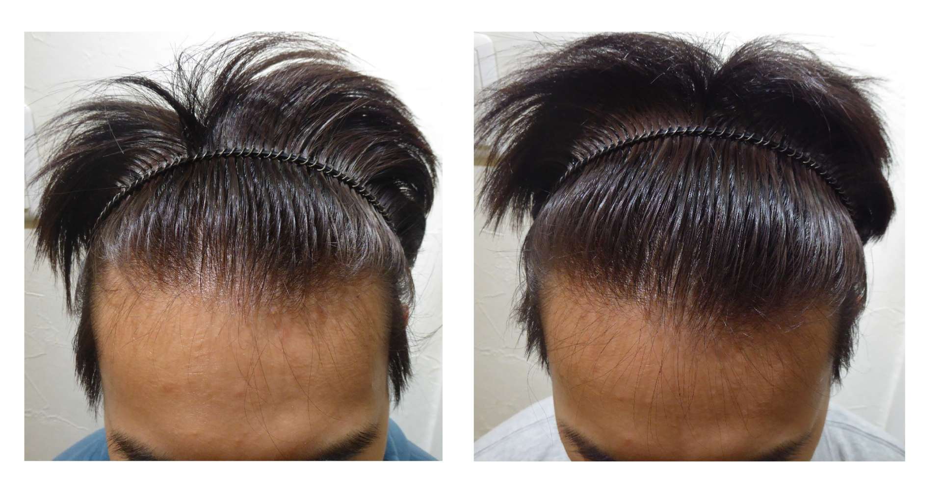 AGA・姫路発毛サロン 発毛にいい食事とは?