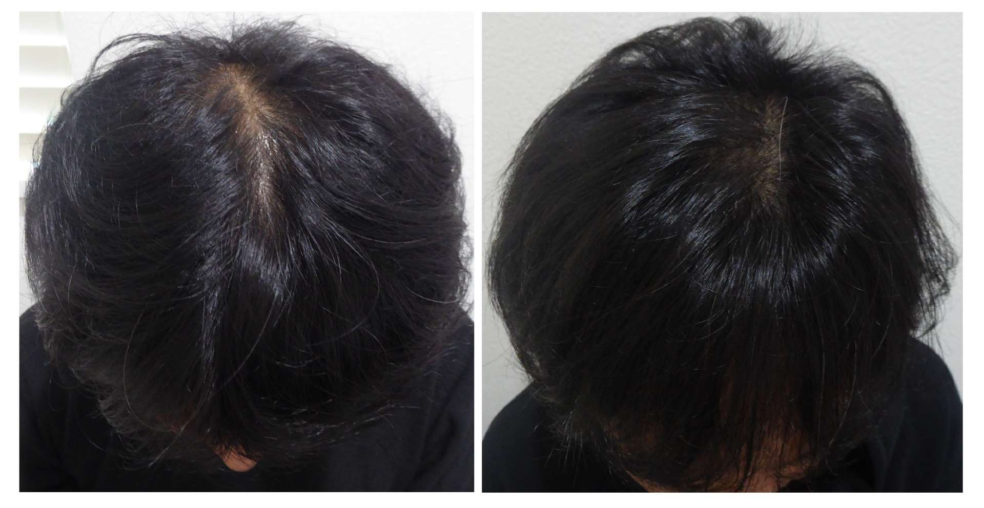 AGA・姫路発毛サロン 〇〇〇ではあまり言われない薄毛の原因