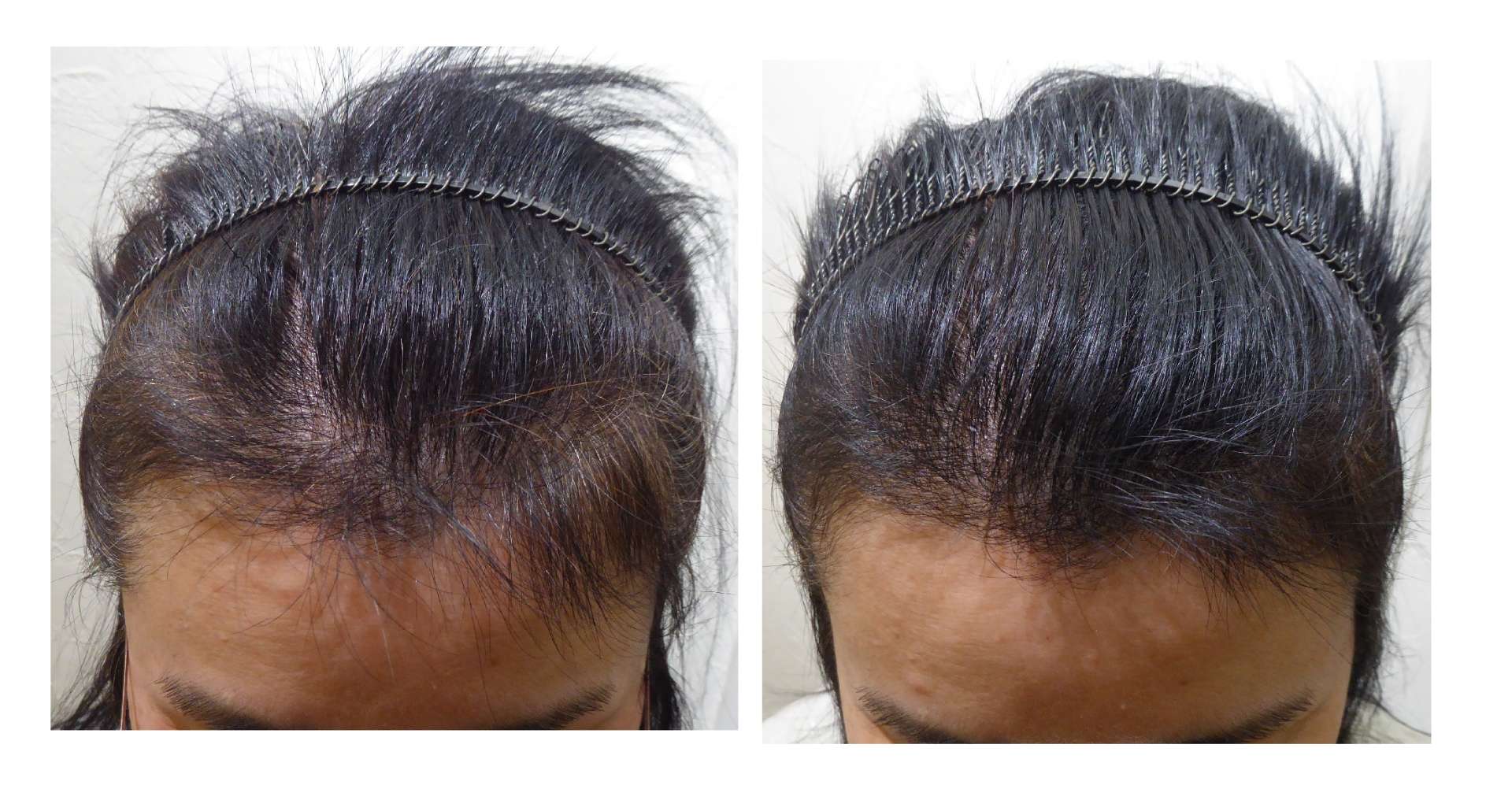 AGA・姫路発毛サロン 春は“発毛に影響が出てくる季節”