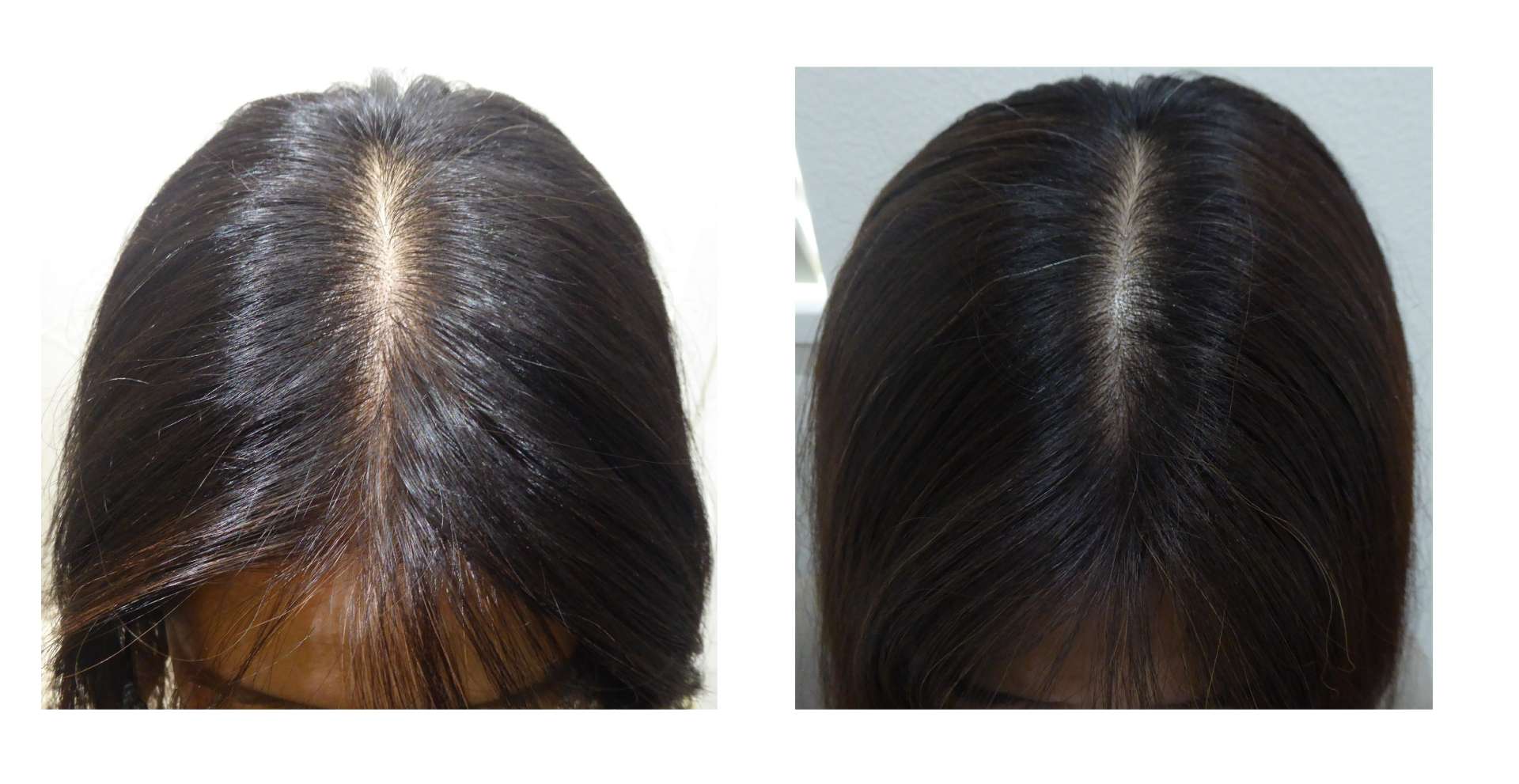 AGA・姫路発毛サロン 発毛は“内側”で決まる!